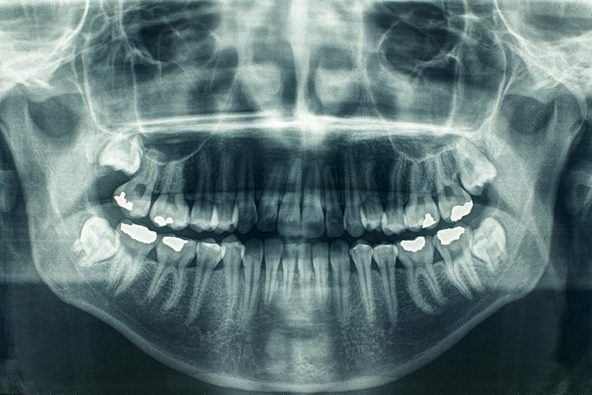 Panoramica dentale  